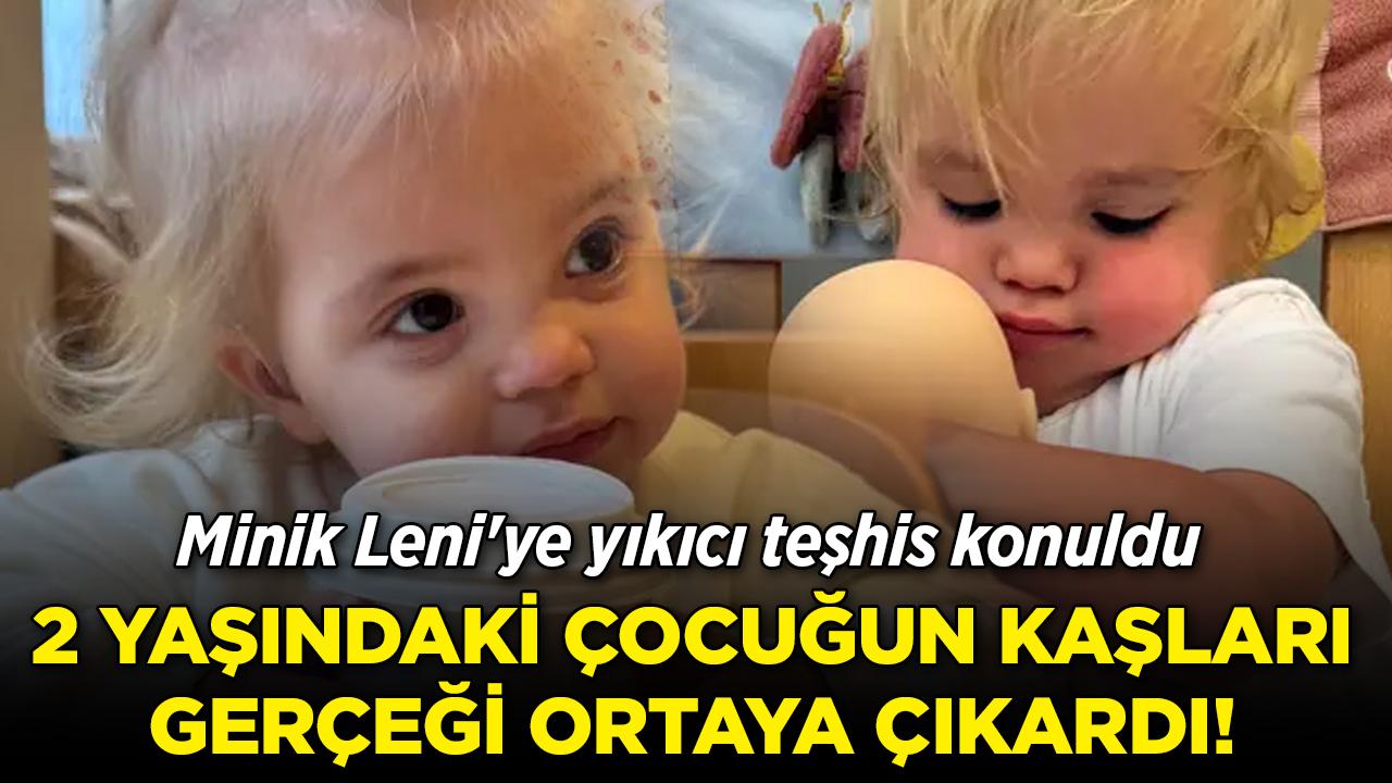 2 yaşındaki çocuğun kaşları gerçeği ortaya çıkardı! Minik Leni'ye yıkıcı teşhis konuldu