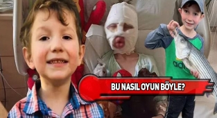 ABD'de Arkadaşı, Çocuğun Yüzünü Ateşe Verdi!