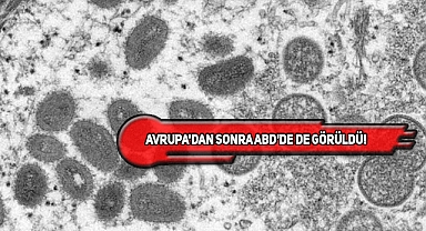 'Maymun Çiçeği Virüsü' ABD'ye de Sıçradı!