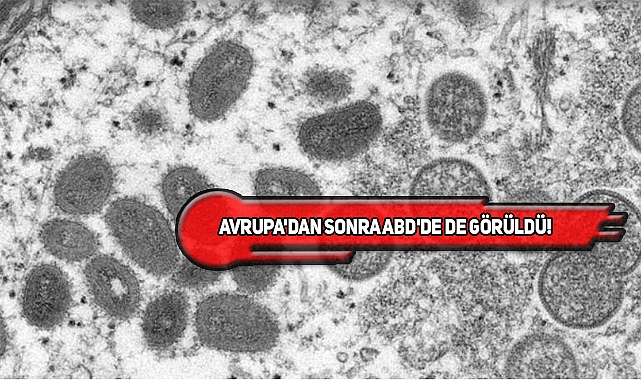 'Maymun Çiçeği Virüsü' ABD'ye de Sıçradı!