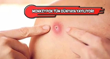 Monkeypox, Türklerin Yoğun Olduğu Şehirde