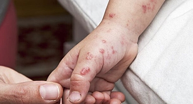 New York'ta İlk Maymun Çiçeği Vakası!