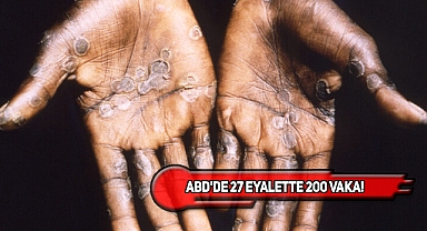 Yeni Küresel Virüs Monkeypox Korkutuyor!