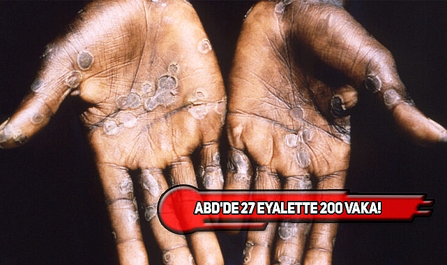 Yeni Küresel Virüs Monkeypox Korkutuyor!