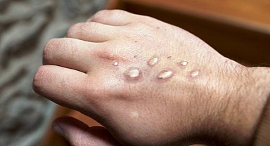 Missouri ve Indiana'da İlk Maymun Çiçeği Vakaları