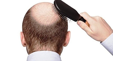 Saçı Dökülenlere Müjde! ABD Bu İlacı Onayladı!