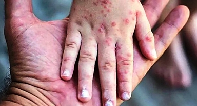 ABD'de İlk! Çocuklarda Maymun Çiçeği Virüsü Görüldü