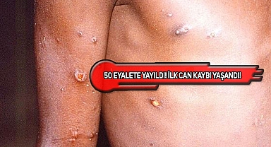 ABD'de İlk Maymun Çiçeği Ölüm Vakası Yaşandı!