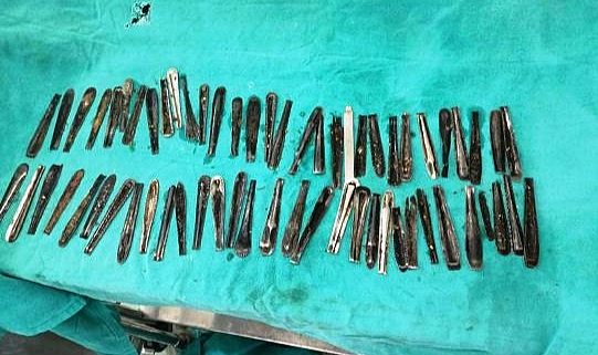 Karın Ağrısı Şikayetiyle Gitiği Hastanede Doktorları Şaşırttı