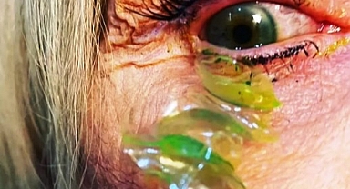 ABD'de Gözünden 23 Kontakt Lens Çıkarıldı