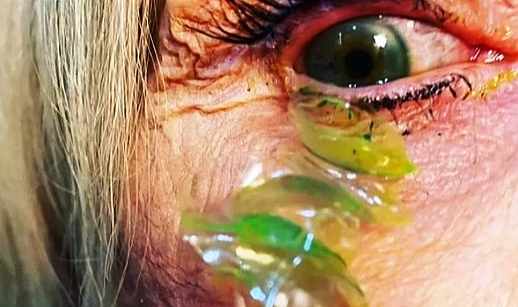 ABD'de Gözünden 23 Kontakt Lens Çıkarıldı