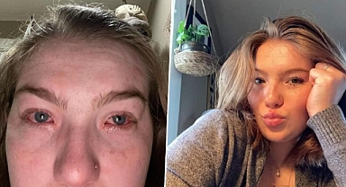 Bu da 'sevgili' alerjisi: Erkek arkadaşı yanına gelince başlıyor...