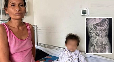 İki yaşındaki çocuğun yuttukları dehşete düşürdü: İşime odaklanmıştım