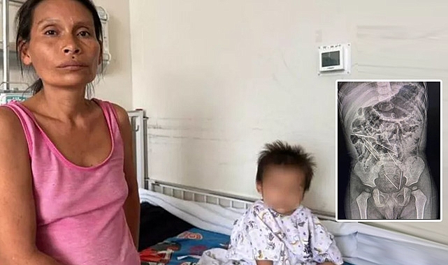 İki yaşındaki çocuğun yuttukları dehşete düşürdü: İşime odaklanmıştım