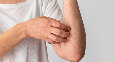 CDC ve DSÖ'den korkutan açıklama: Kızamık kaynaklı ölümlerde artış!