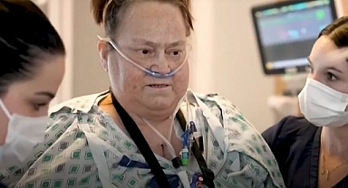 Domuz Böbreği Nakli Olan 54 Yaşındaki Lisa Pisano, Hayatını Kaybetti!