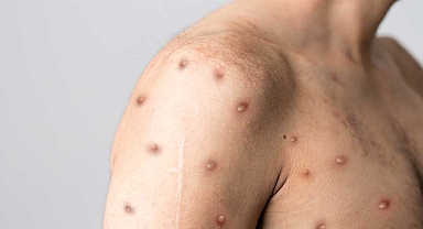 Maymun Çiçeği Salgını Artıyor Acil Durum İlan Edildi