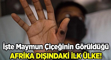 Maymun Çiçeği Yayılıyor! İşte Görüldüğü Afrika Dışı İlk Ülke
