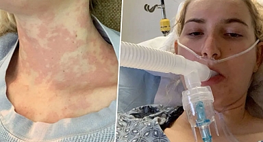 Hastalığı sevgililerinden etti, hayatına yeni 3 kural getirdi: Ünlü isimler de bu sorundan muzdarip