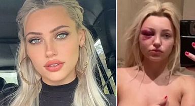 New York'ta korkunç olay: Genç model doktor tarafından önce dövüldü sonra tecavüze uğradı!