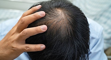 Türk akademisyenler yapay zeka destekli "Ke-Bot" cihazıyla saç ekimini devrimsel hale getirdi 