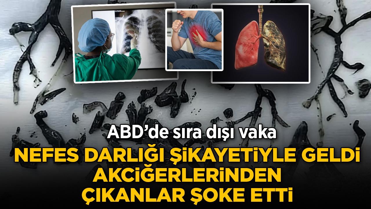 ABD'de sıra dışı vaka: Nefes darlığı şikâyetiyle geldi, sonuç herkesi şaşırttı