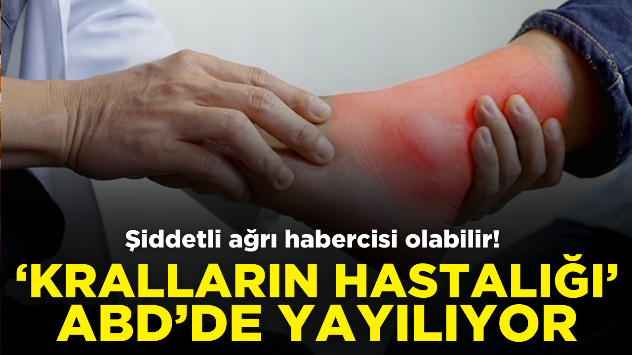 "Kralların hastalığı" ABD'de yayılıyor: Uzmanlar milyonlar için uyardı