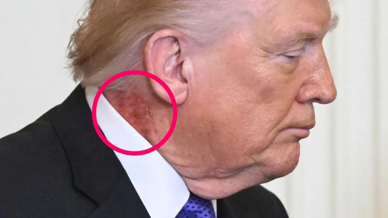 Trump'ın Boynundaki İz Spekülasyonlara Neden Oldu: Beyaz Saray Açıklama Yaptı